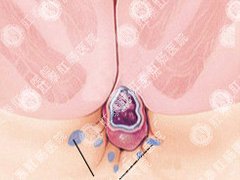 兰州医博肛肠医院：肛门湿疹的危害有哪些？