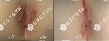 原发性肛门湿疹治疗前后对比图